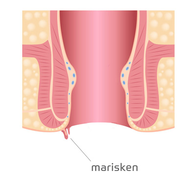 Marisken behandelen huidflapje