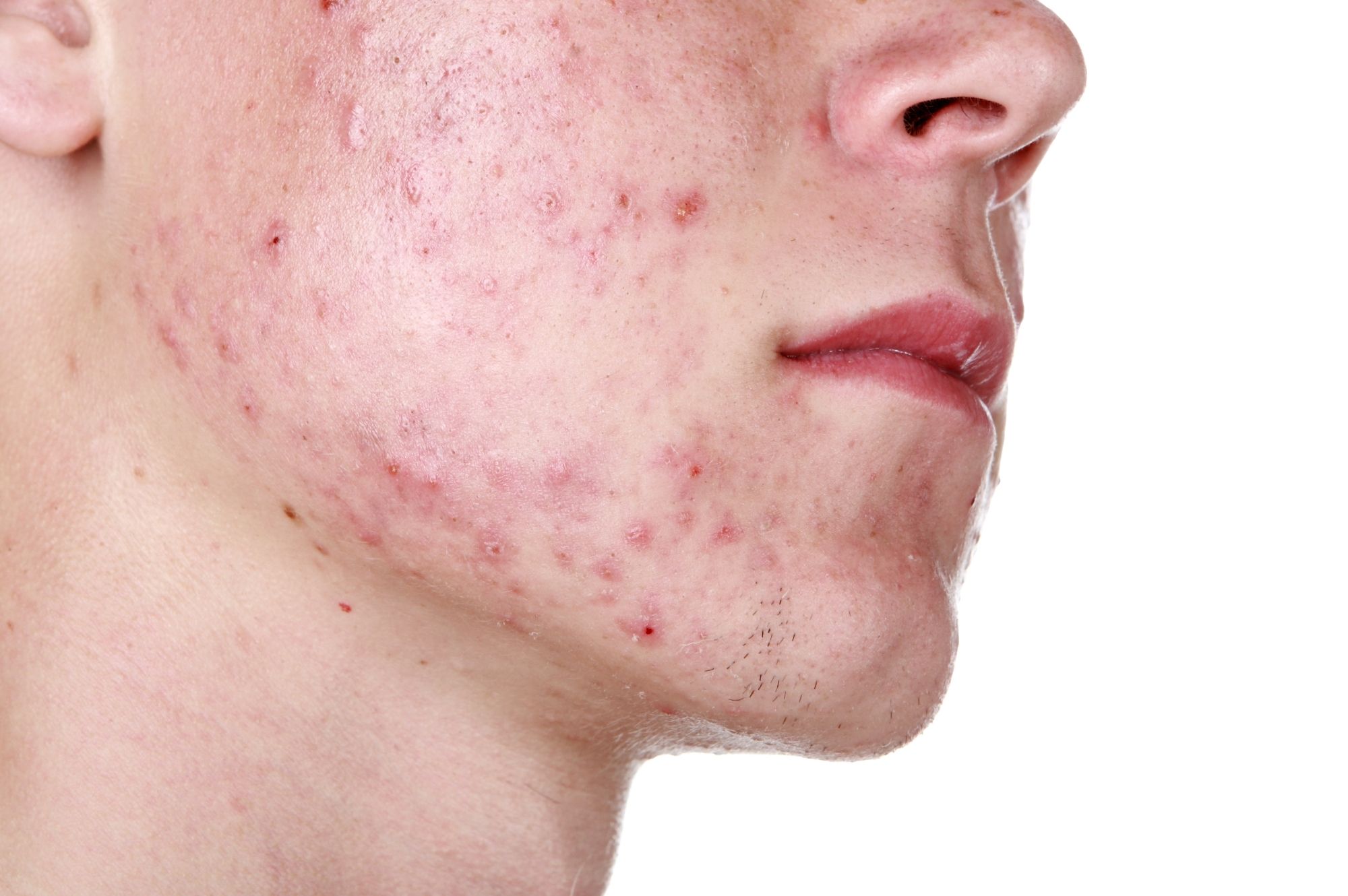 methodologie waterbestendig huwelijk Alles over acne - Polikliniekdeblaak.nl