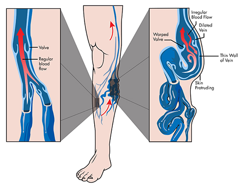 varices behandelen