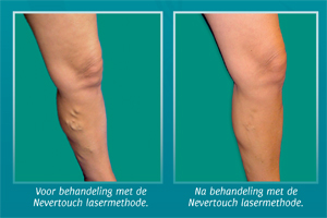 lasermethode spataderen behandelen angiodynamics nevertouch