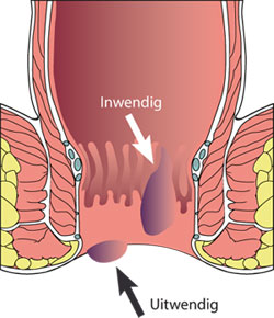 aambeien behandelen bij de proctoloog van Polikliniek de Blaak