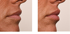 lip fillers foto voor en na de behandeling