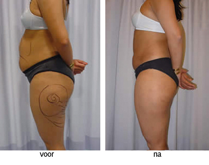 liposuctie voor na foto liposculptuur