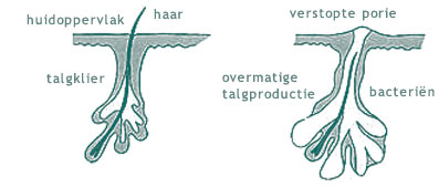acne ontstaat door verstopte porien bij de talgklier onder de huid