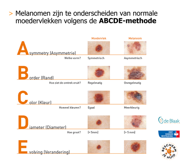 melanoom huidkanker moedervlek zelftest