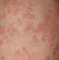 psoriasis behandelen