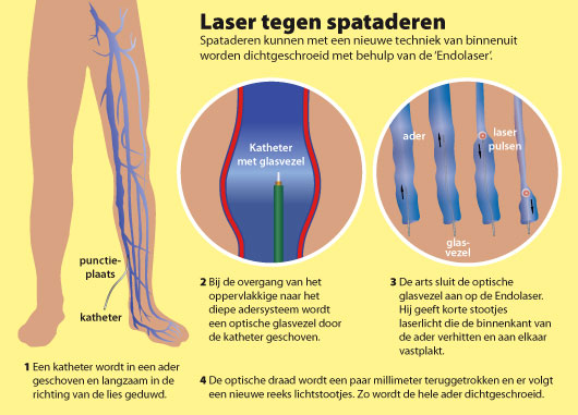 spataderen laseren en behandelen bij de fleboloog van ziekenhuis de Blaak