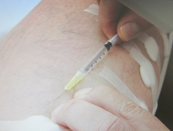 spataderen inspuiten sclerocompressietherapie