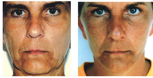 voor-en-na-foto facelift