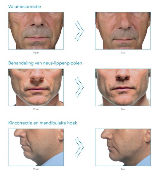 voor- en na foto's injectables mannen