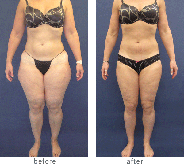 lipoedema liposuction before and after photo